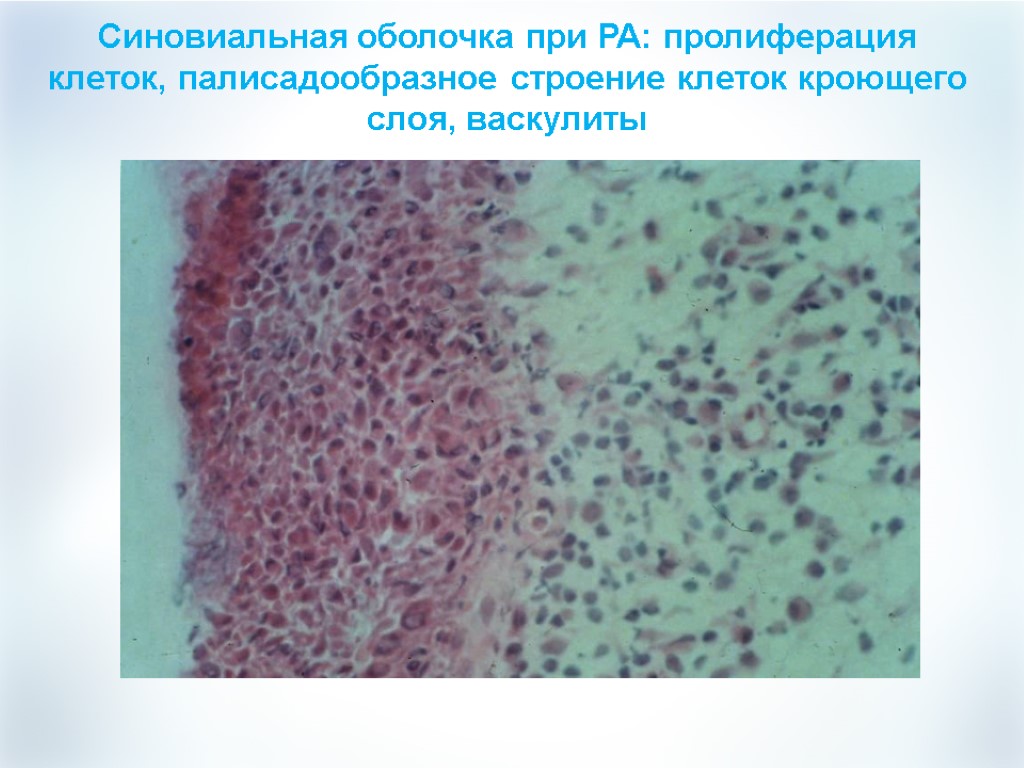 Синовиальная оболочка при РА: пролиферация клеток, палисадообразное строение клеток кроющего слоя, васкулиты